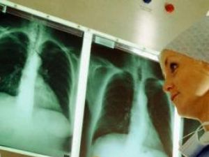 În prezent medicina nu prea reuşeşte să combată cancerul pulmonar. Foto: CORBIS