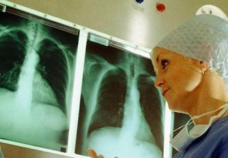 În prezent medicina nu prea reuşeşte să combată cancerul pulmonar. Foto: CORBIS