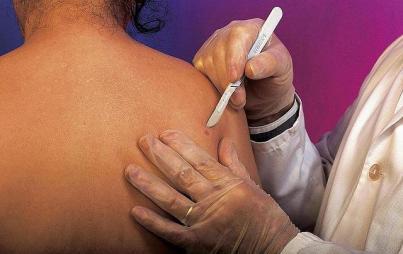 Medicii americani au reuşit în premieră să trateze cu succes un pacient atins de cea mai gravă formă de cancer de piele. Foto: F1ONLINE