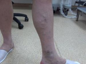 tratamentul venelor varicoase în tatarstan