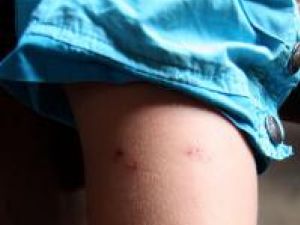 Medicii recomandă să se evite lezarea zonelor cu înţepături de ţânţari