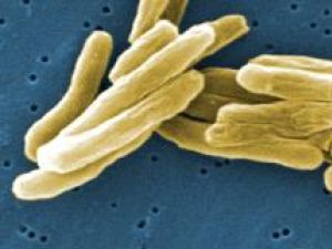 Test pentru diagnosticarea tuberculozei în două ore, descoperit de cercetători