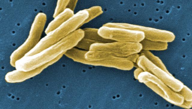 Test pentru diagnosticarea tuberculozei în două ore, descoperit de cercetători