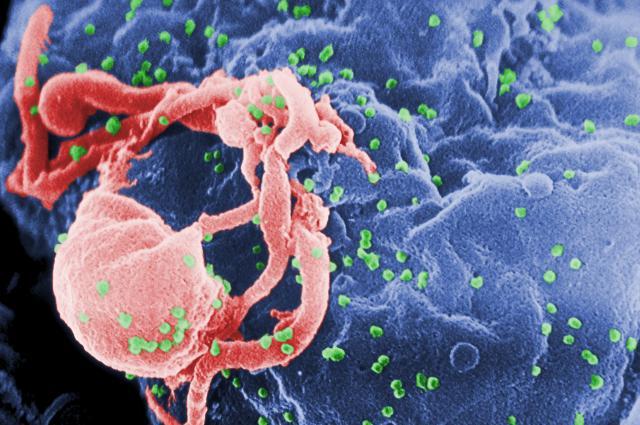 SIDA: Virusul imunodeficienţei, mult mai vechi decât se credea