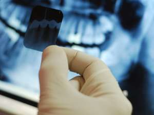 Radiografiile dentare pot cauza tumori cerebrale
