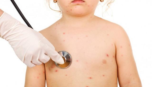 Peste 300 de suceveni s-au îmbolnăvit în primele două luni ale anului de varicelă. Foto www.cugetliber.ro