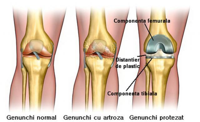 Procedură protezare genunchi