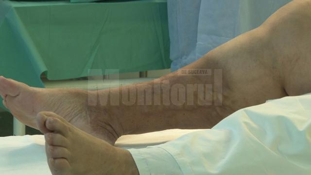 Chirurgii ortopezi suceveni i-au montat, ieri, un genunchi artificial unei femei din Botoşani
