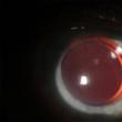 Ochi operat de cataracta cu implant de cristalin foldabil