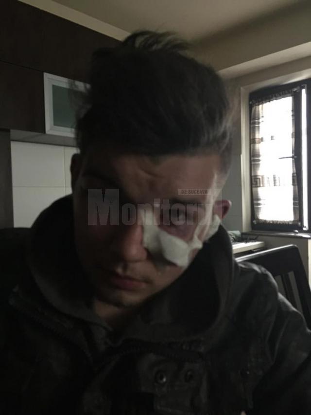În urma bătăii, Eduard Dura a ajuns la Urgenţele Spitalului Judeţean, cu ochii umflaţi şi multiple vânătăi şi urme de lovituri, în principal în zona feţei