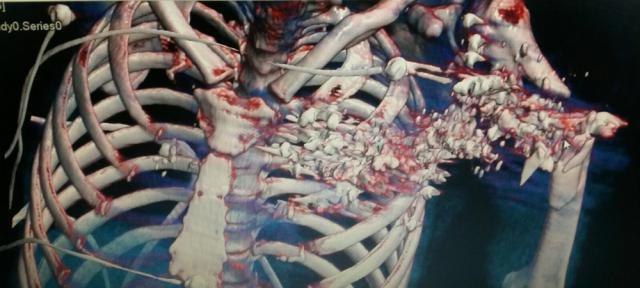 Imaginea leziunii suferite de tânărul împușcat, în format 3D