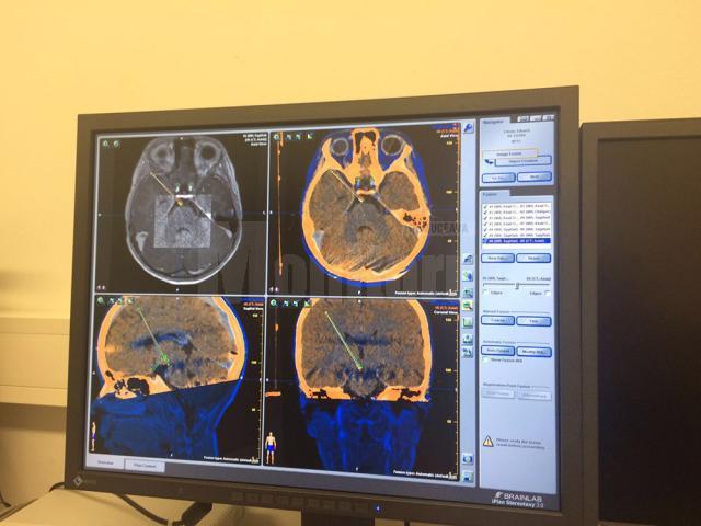 Formă de epilepsie care apare un caz la un milion, diagnosticată la un copil, de dr. Anna Miron, de la Centrul de Epilepsie al Spitalului de Urgență Suceava