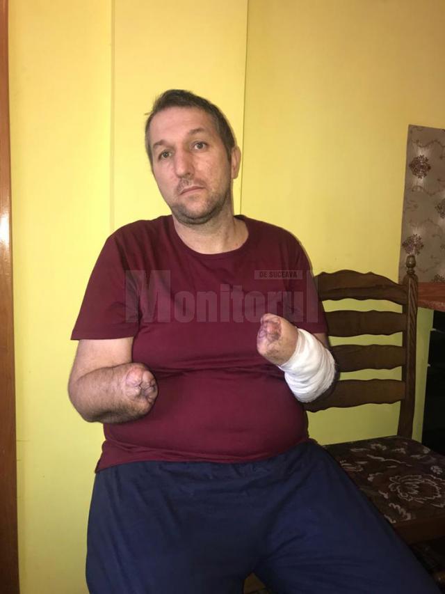 Un bărbat din Bădeuţi cu ambele mâini amputate are nevoie urgent de proteze