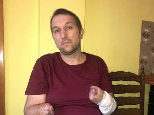 Constantin Cazac, în vârstă de 40 de ani, cu ambele mâini amputate, în urma unui accident, are nevoie urgent de două proteze