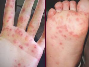 Boala „Gură-mână-picior” Foto: sfaturi medicale