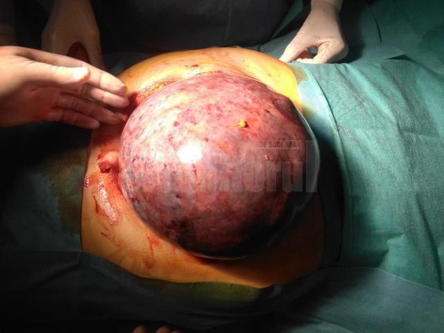 Tumoră de 5,2 kg, extirpată ieri cu succes unei paciente de 62 de ani, la Spitalul de Urgenţă Suceava
