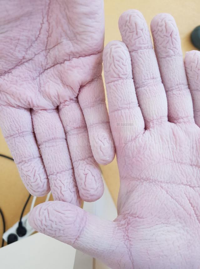 Cum arată mâinile unui asistent medical, după 12 ore de muncă, sub 3 perechi de mănuși chirurgicale