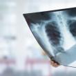 Radiografie a plămânilor. Foto sfatul medicului.ro