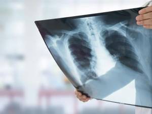 Radiografie a plămânilor. Foto sfatulmedicului.ro