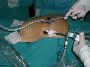Plasarea cateterului de dializă peritoneală