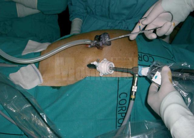 Plasarea cateterului de dializă peritoneală