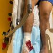 Încă un tânăr accidentat după ce a alunecat pe gresia udă la ștrandul de la Ițcani
