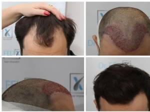 Clinică specializată în implant de păr - aflați din acest articol de Dr Felix Hair Implant