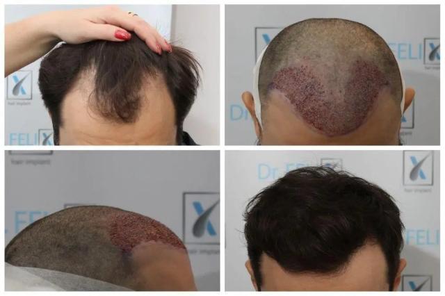 Clinică specializată în implant de păr - aflați din acest articol de Dr Felix Hair Implant