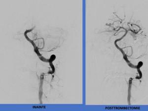 SCJU Suceava este singurul centru de tratament endovascular al AVC din Moldova