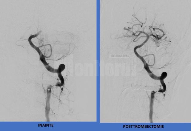 SCJU Suceava este singurul centru de tratament endovascular al AVC din Moldova