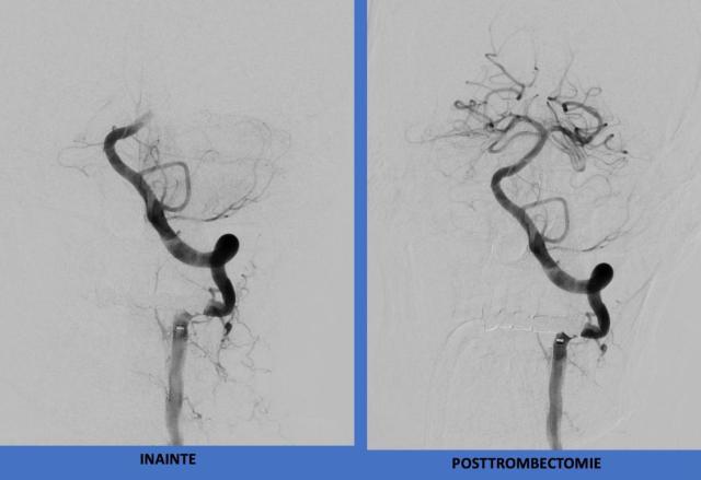 SCJU Suceava este singurul centru de tratament endovascular al AVC din Moldova