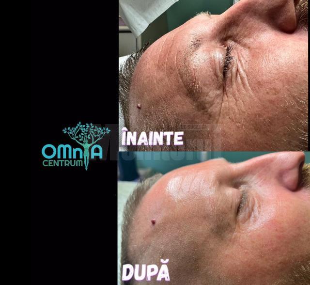 Ininte si dupa