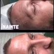 Lifting Facial Nechirurgical cu ajutorul noilor tehnologii revoluționare, la Omnia Centrum!