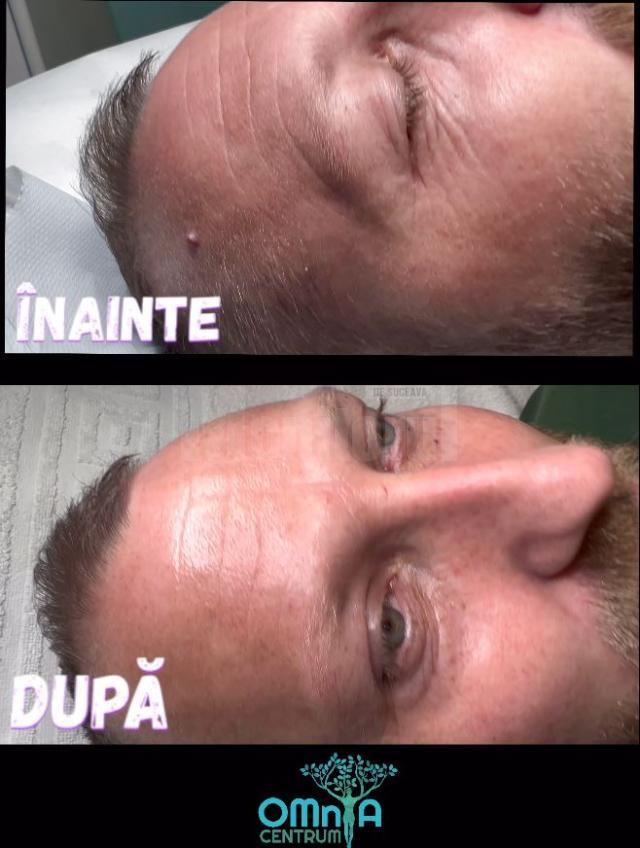 Lifting Facial Nechirurgical cu ajutorul noilor tehnologii revoluționare, la Omnia Centrum!
