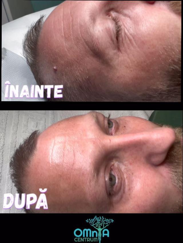 Lifting Facial Nechirurgical cu ajutorul noilor tehnologii revoluționare, la Omnia Centrum!