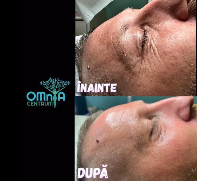 Lifting Facial Nechirurgical cu ajutorul noilor tehnologii revoluționare, la Omnia Centrum!