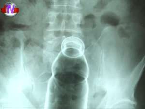 Un botoşănean de 46 de ani a ajuns la Spitalul Judeţean Suceava după ce şi-a băgat o sticlă în anus